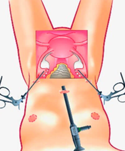 Laparoscopic Myomectomy fibroid treatment