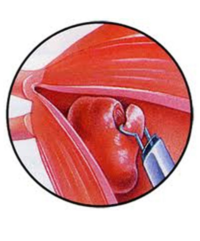Fibroids removal Through the Vagina