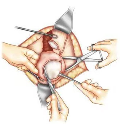fibroid removal with 10cm cuts in the abdominal