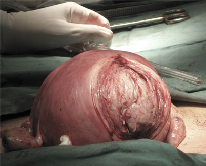 fibroid Surgery Singapore