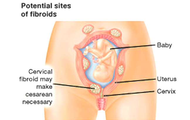 Fibroids Grow in Pregnancy