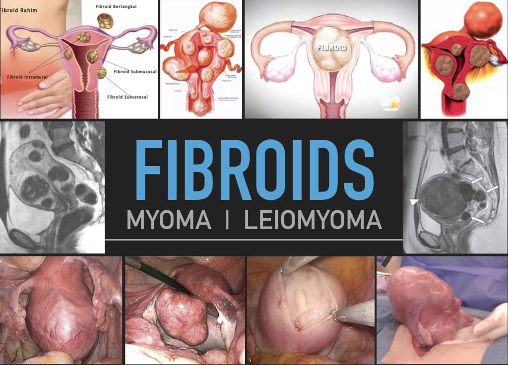 fibroid Myoma and Leiomyoma Cancer