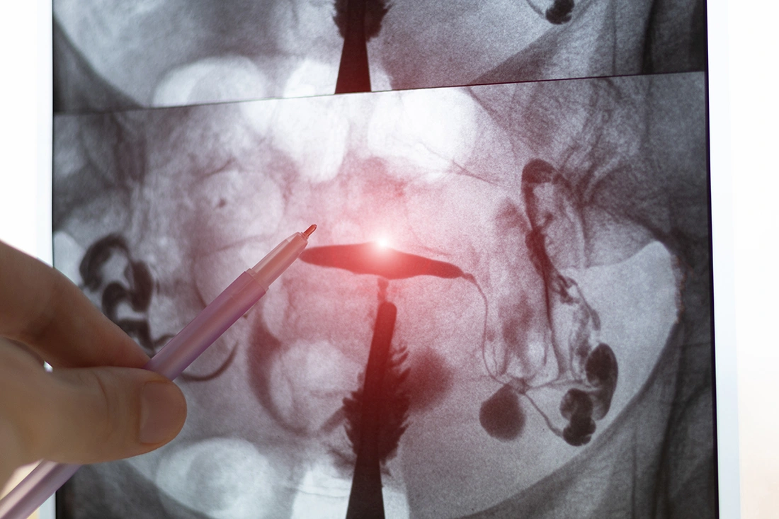 Fibroid surgeon using a pen to point out a highlighted area on a uterine scan