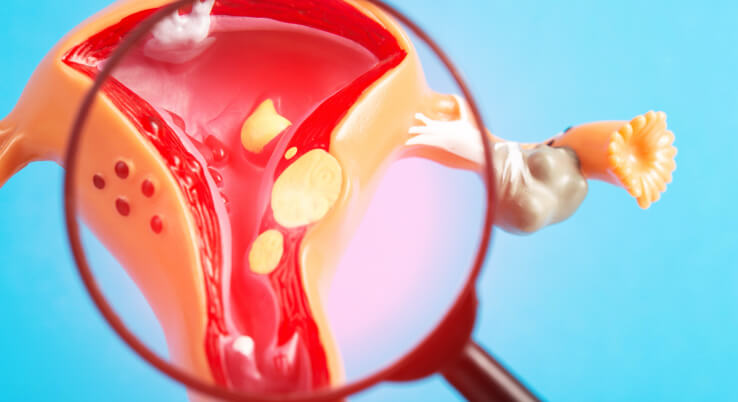 Fibroid & Cancer