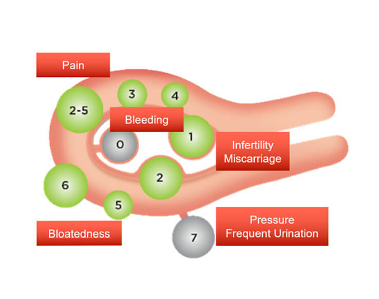 What Are Fibroids?