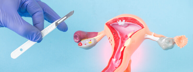 Fibroid Surgery