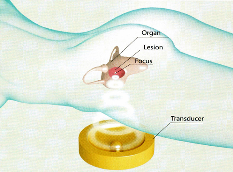 High-intensity Focused Ultrasound