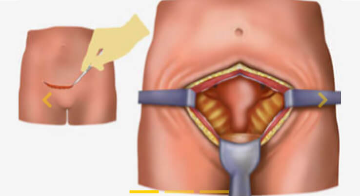 Laparotomy Myomectomy