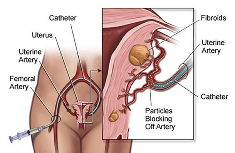 Uterine Artery Embolisation